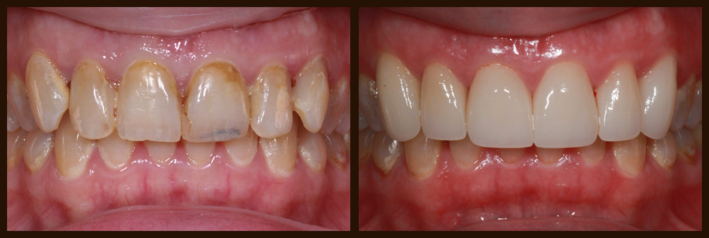  A before and after case study of an actual patient of Dr. Nichole Martin in Lynnwood, WA