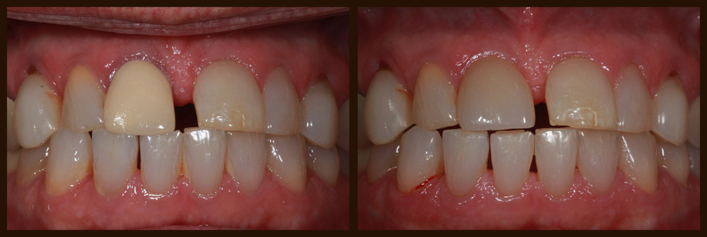  A before and after case study of an actual patient of Dr. Nichole Martin in Lynnwood, WA